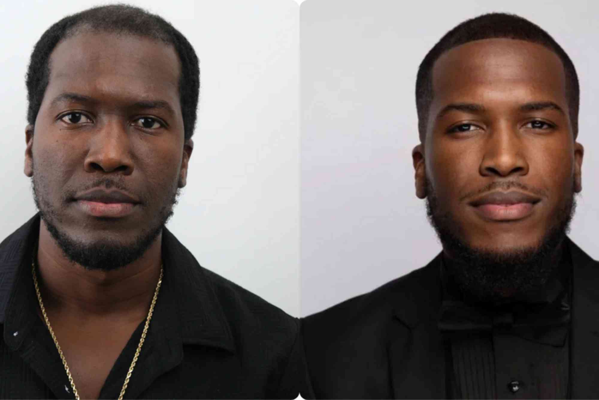 Hair Transplant Turkey